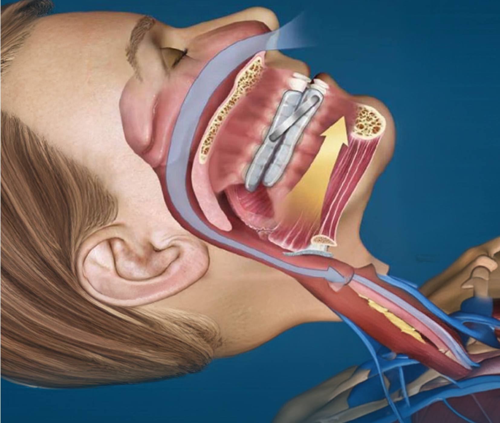 Évaluation de l’efficacité de l’orthèse d’avancée mandibulaire T-Dream®