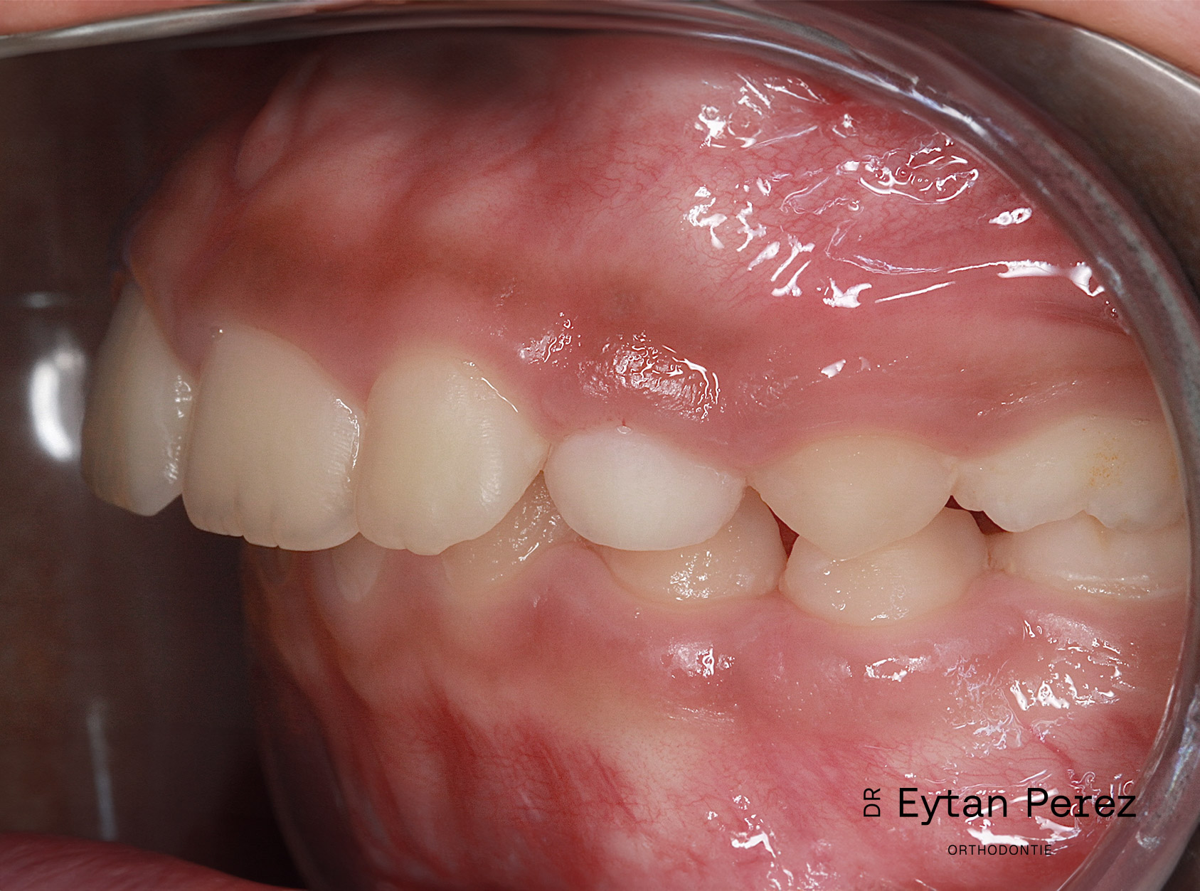 cas-11-c-gauche-avant