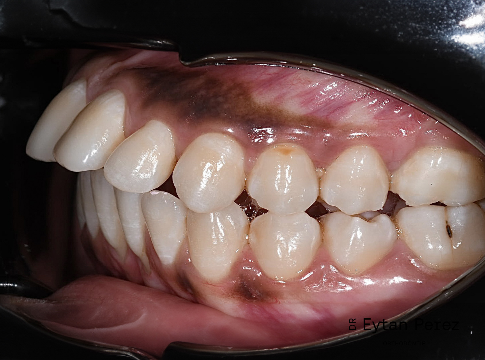 cas-13-c-gauche-avant