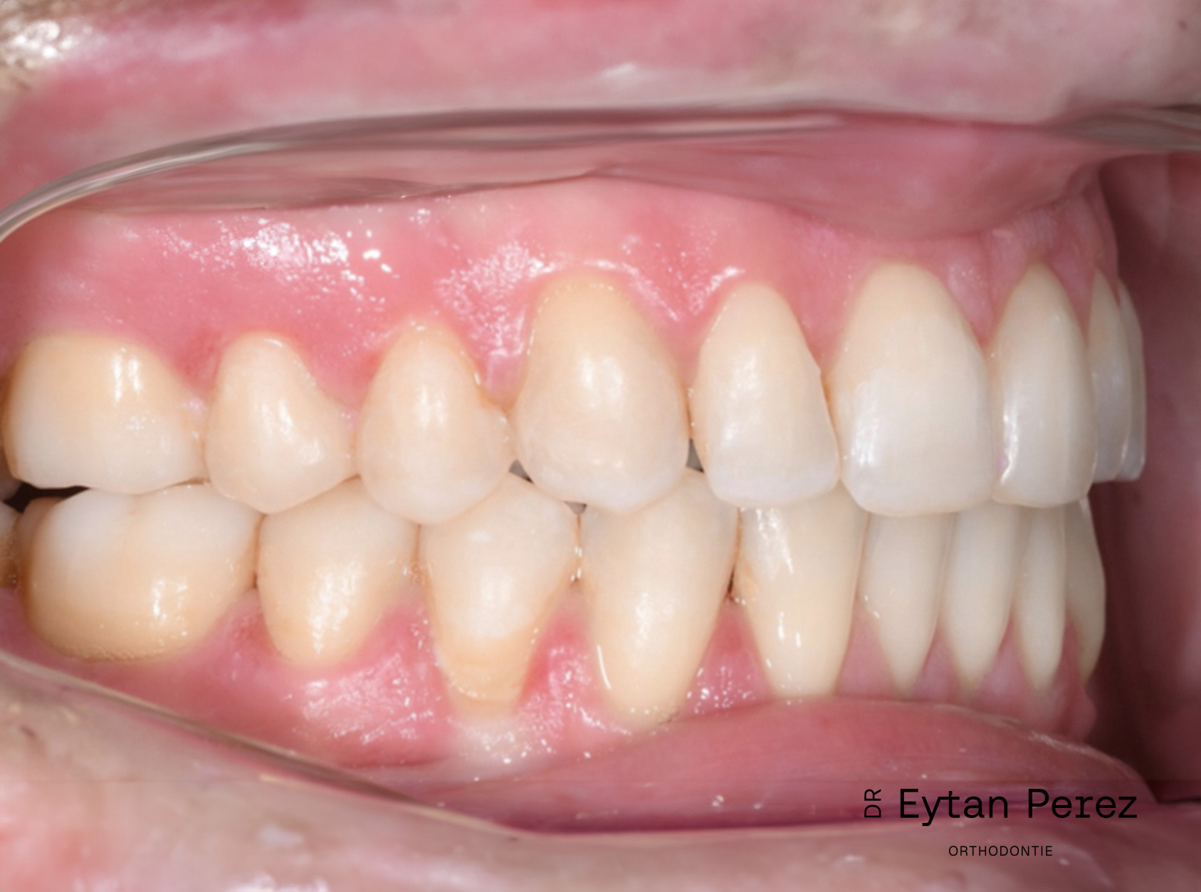 cas-15-c-droit-apres