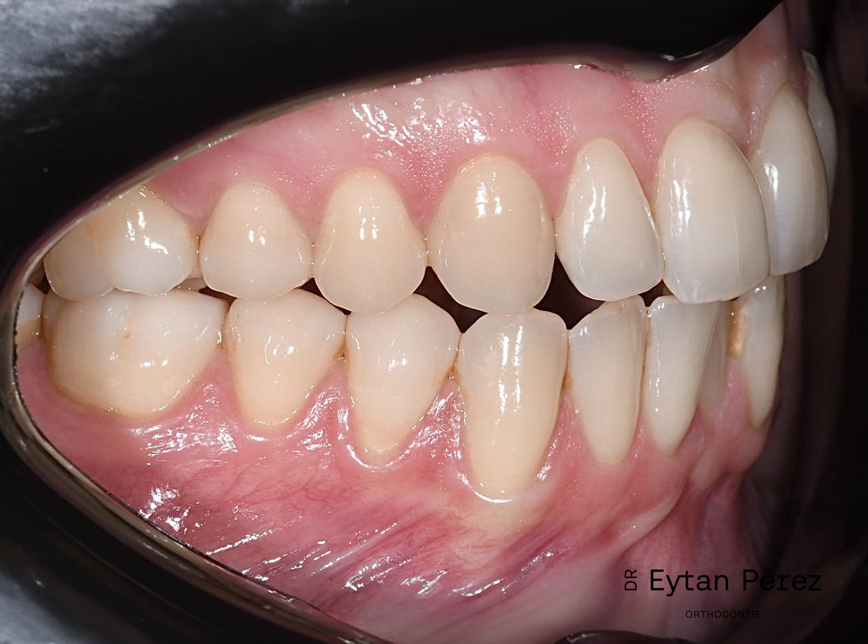 cas-15-c-droit-avant