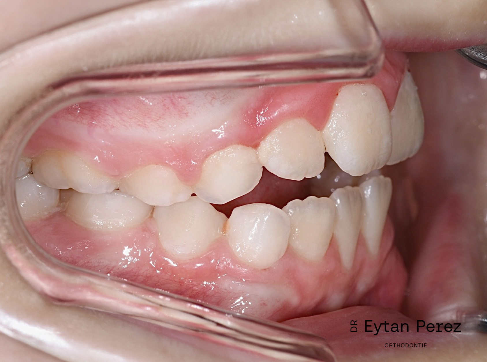 cas-16-c-droit-avant