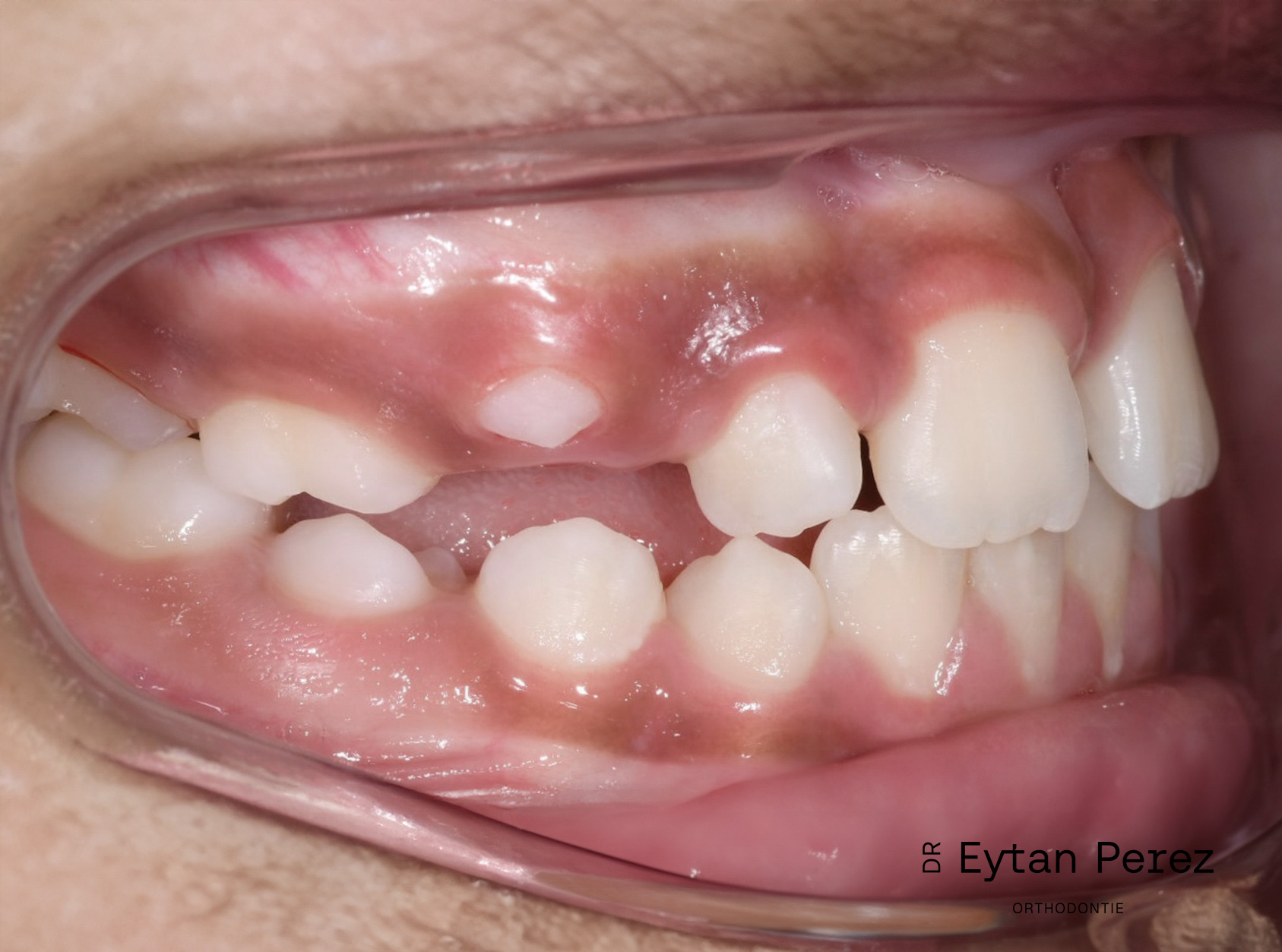 cas-17-c-droit-apres