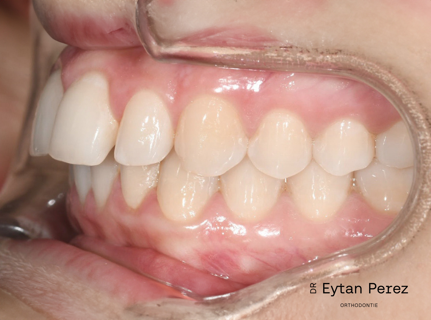 cas-18-c-gauche-avant