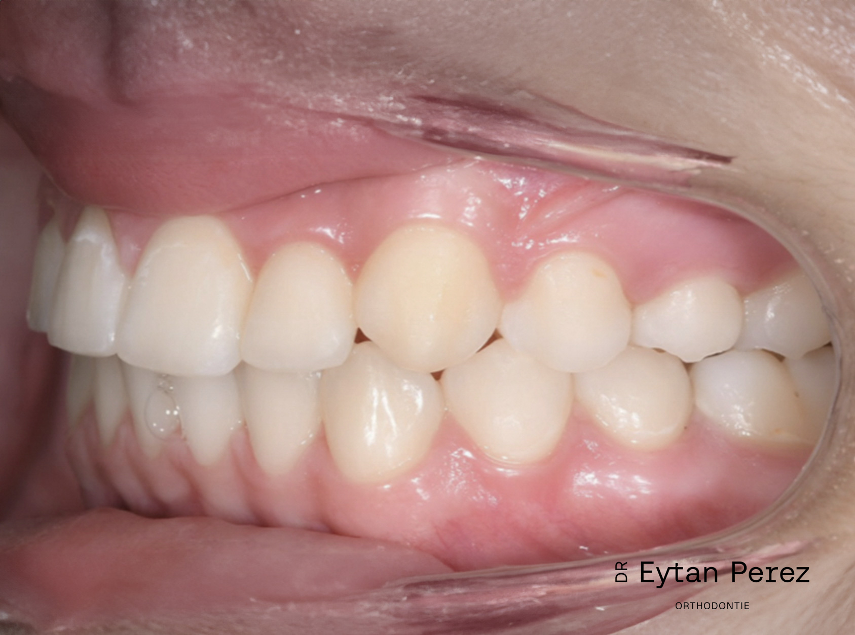 cas-21-c-gauche-apres