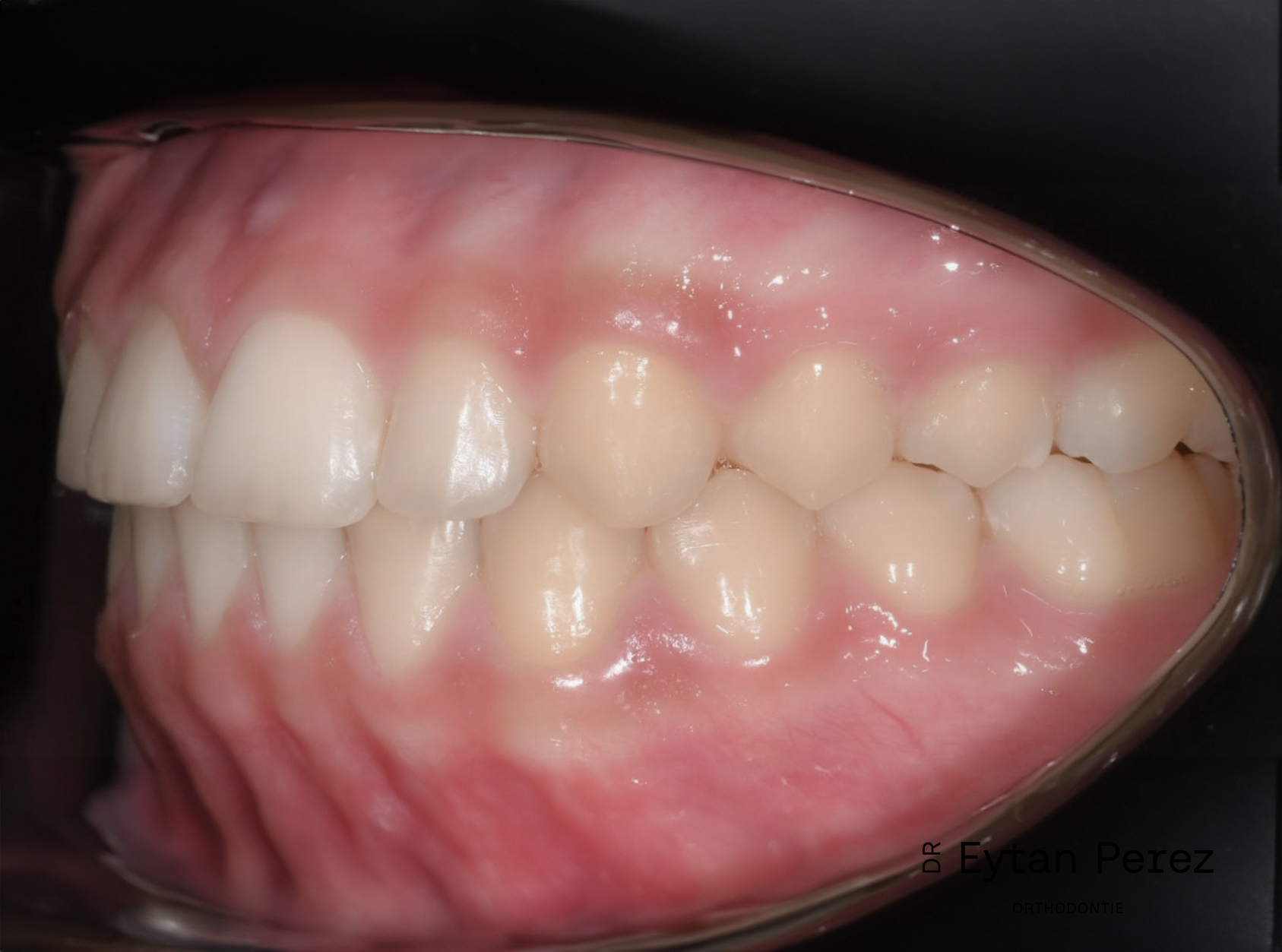 cas-11-c-gauche-apres