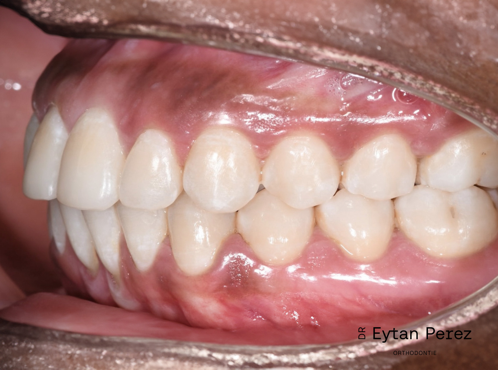 cas-13-c-gauche-apres