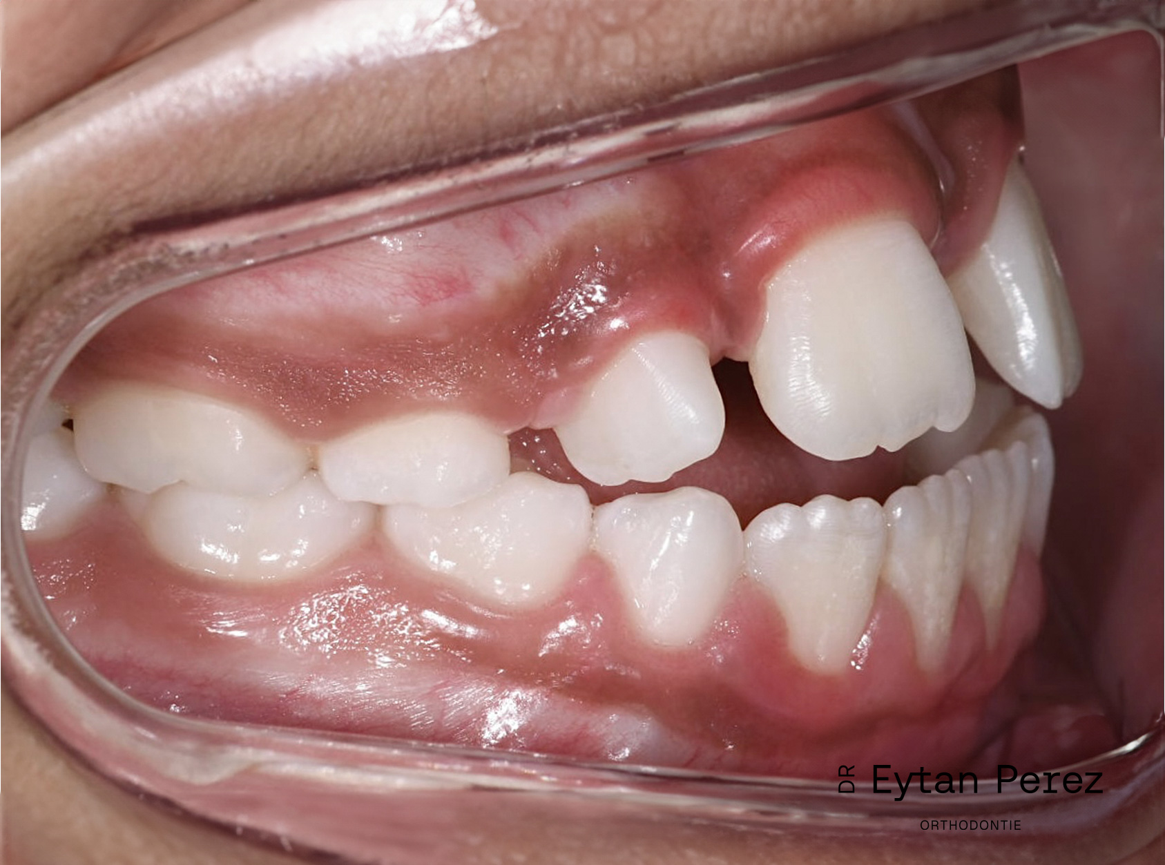 cas-17-c-droit-avant