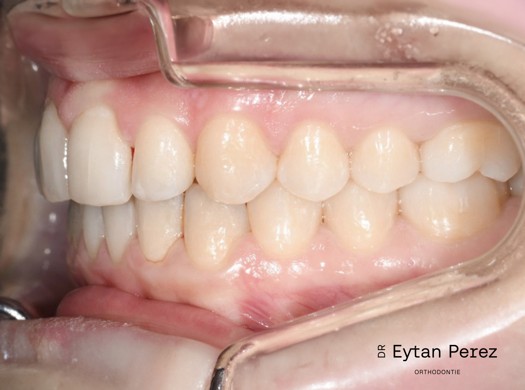 cas-18-c-gauche-apres