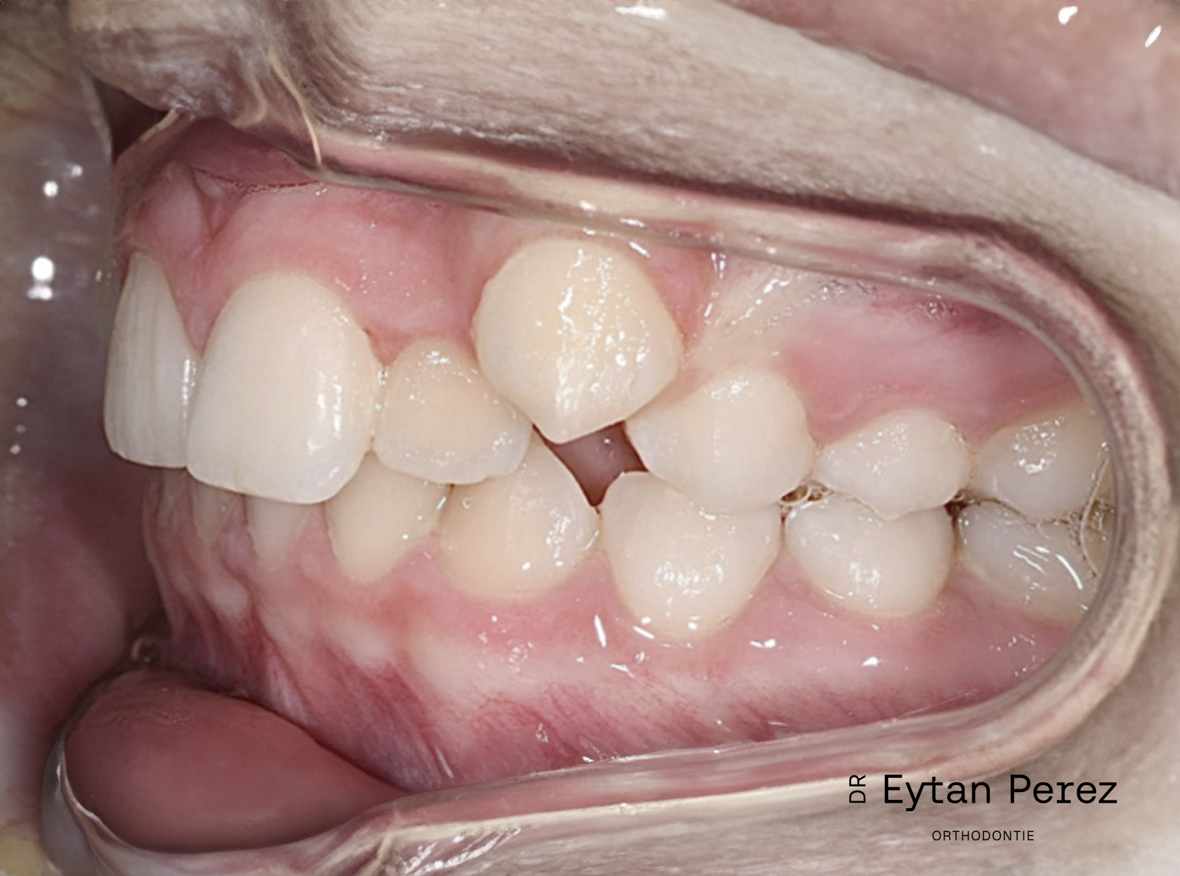 cas-21-c-gauche-avant